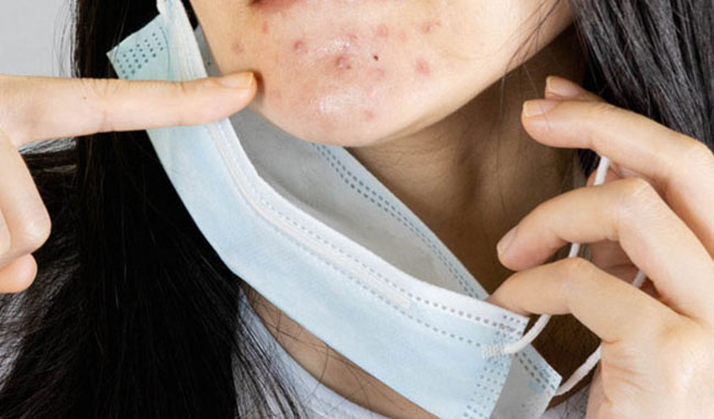 Maske est l'acné dont tout le monde parle en ces temps de crise pandémique. 