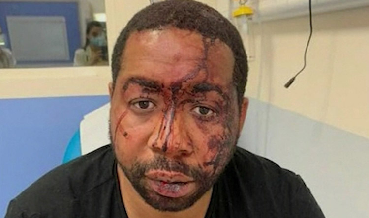 Le jeune producteur a été défiguré tant les coups que les policiers lui ont porté au visage étaient violents. 